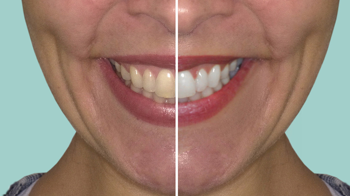 Before and After using Cool Blue Platinum