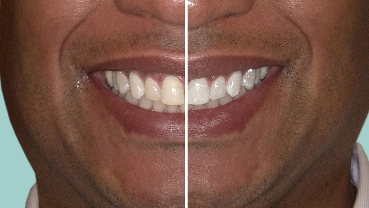 Before and After using Cool Blue Platinum