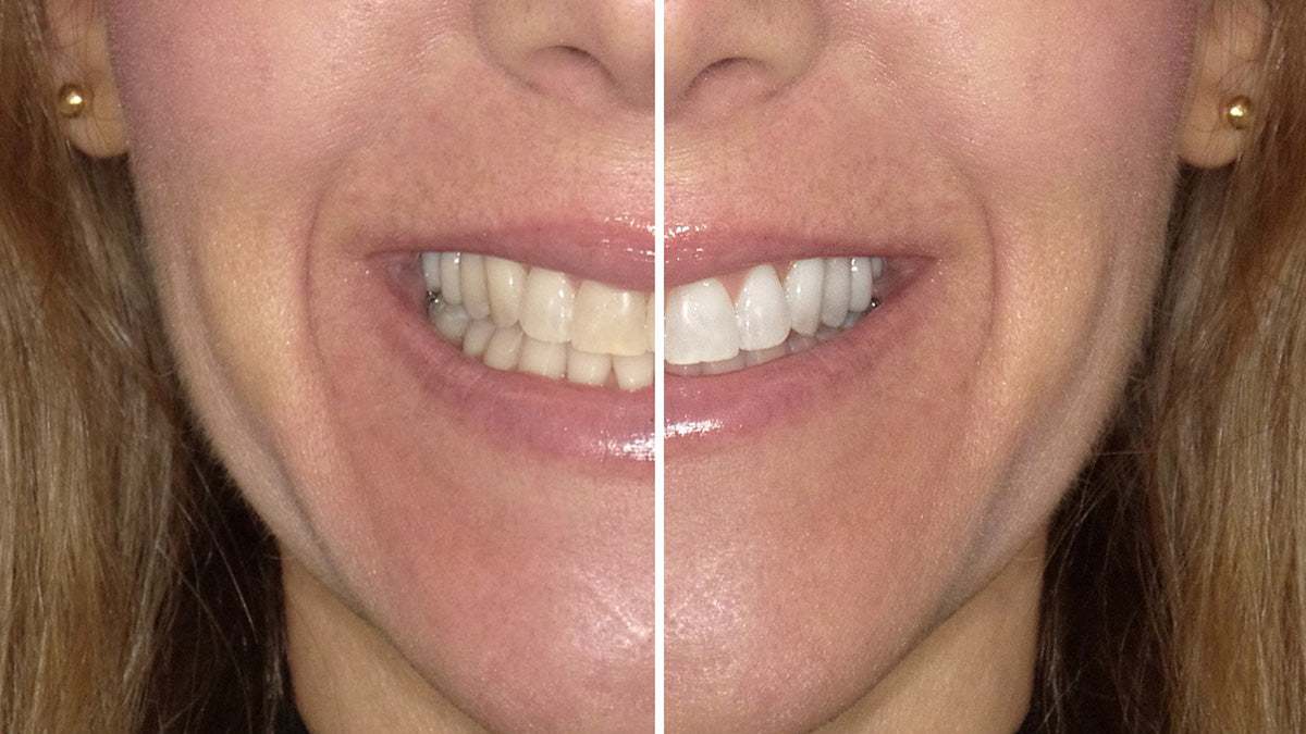 Before and After using Cool Blue Platinum