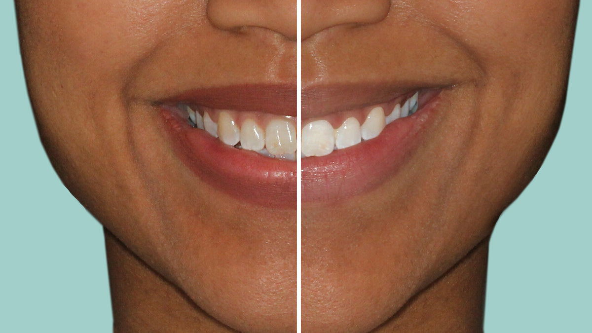 Before and After using Cool Blue Platinum