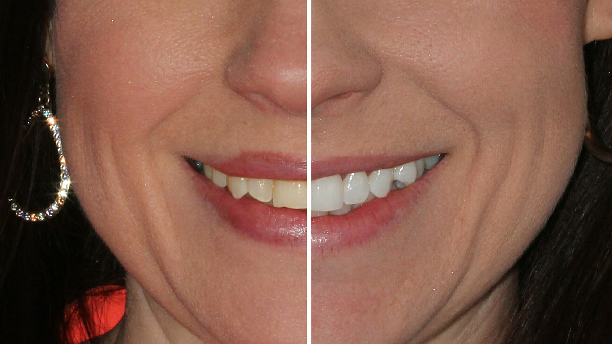 Before and After using Cool Blue Platinum