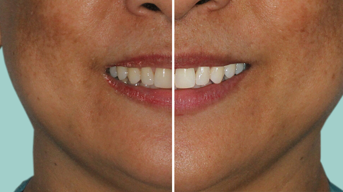 Before and After using Cool Blue Platinum